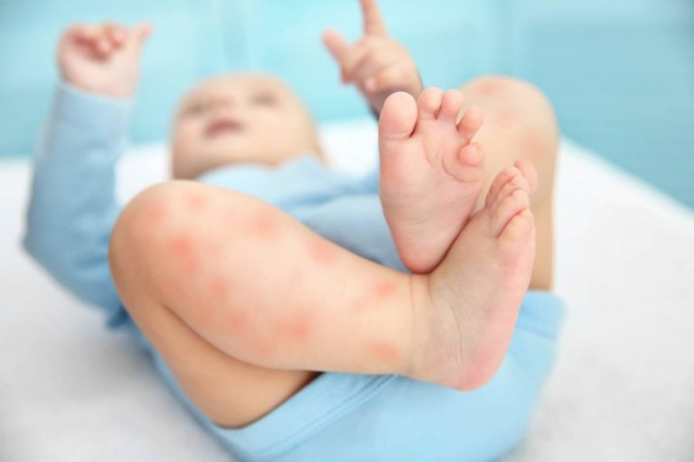 Bệnh ngoài da ở trẻ sơ sinh: Những vấn đề về da bé sơ sinh dễ mắc phải