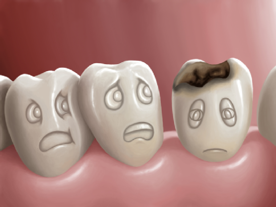 Bé bị sâu răng: 10 cách đánh bay nỗi lo sâu răng ở trẻ