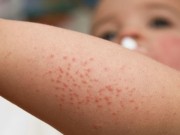 Trị rôm sảy cho bé: Cẩn tắc vô ưu!