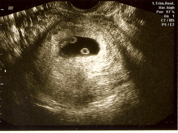 Quá trình phát triển của thai nhi sinh đôi