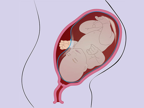 Dải sợi ối - Biến chứng nguy hiểm gây dị tật thai nhi