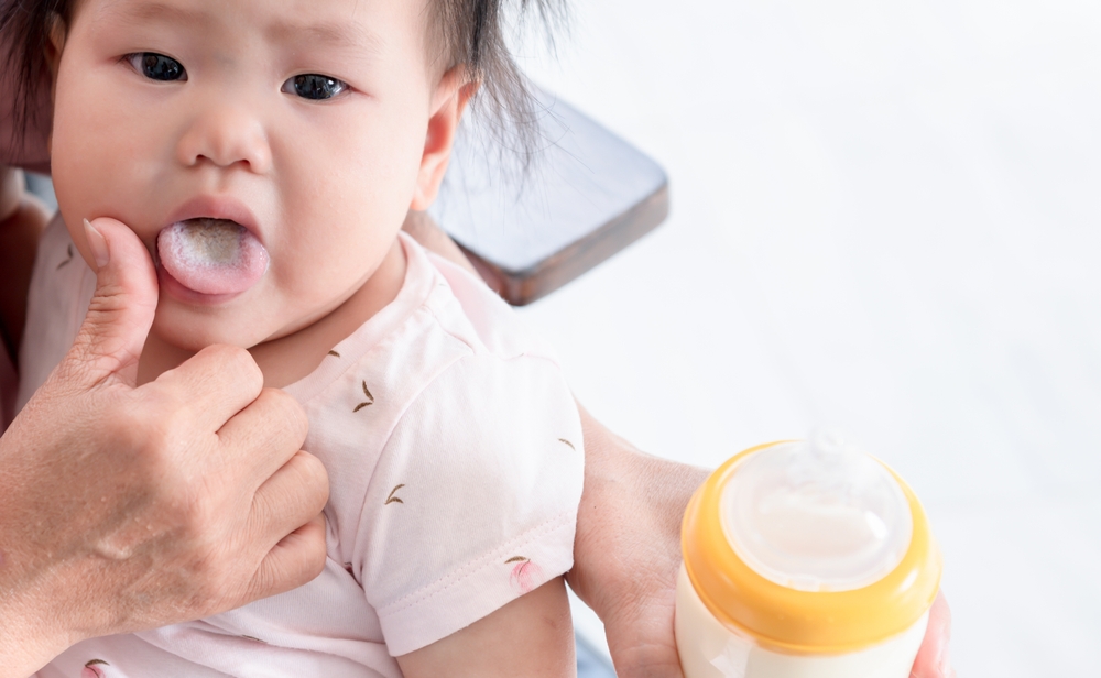 Trẻ sơ sinh bị trắng lưỡi? Nguyên nhân và cách rơ lưỡi cho trẻ