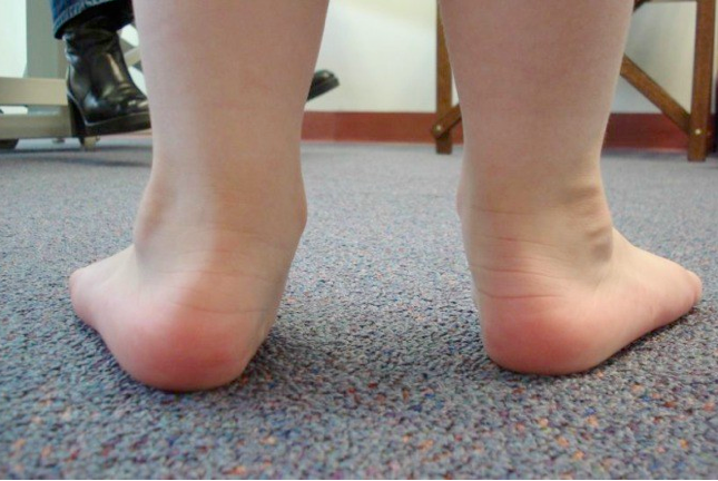 Bàn chân bẹt ở trẻ em 