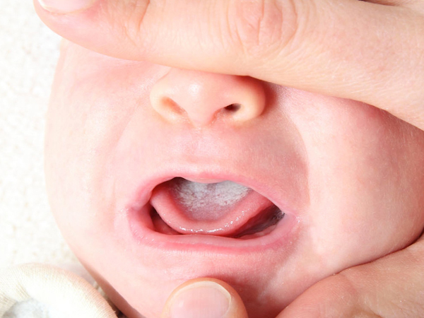 Nấm miệng ở trẻ sơ sinh: Nguyên nhân, dấu hiệu và cách chữa trị