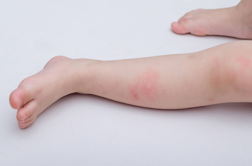 Trị vết thâm muỗi đốt lâu ngày cho bé - Mẹ phải làm sao?