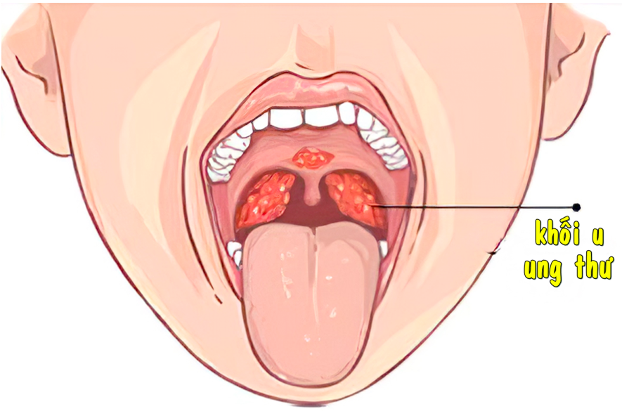 Các dạng ung thư vòm họng