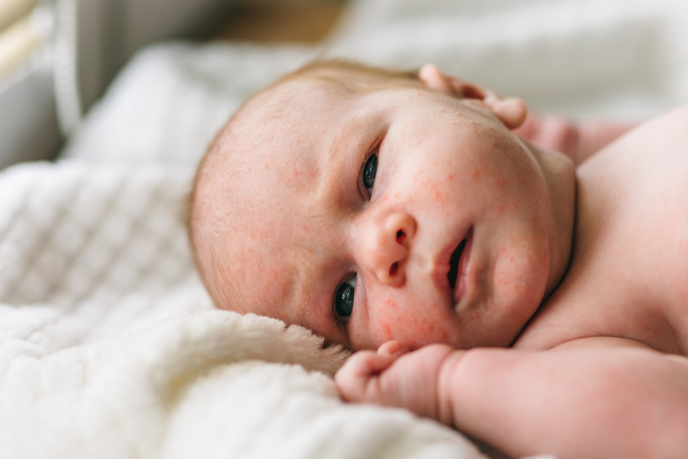 Mụn sữa ở trẻ sơ sinh có phải là dấu hiệu của bệnh da liễu?