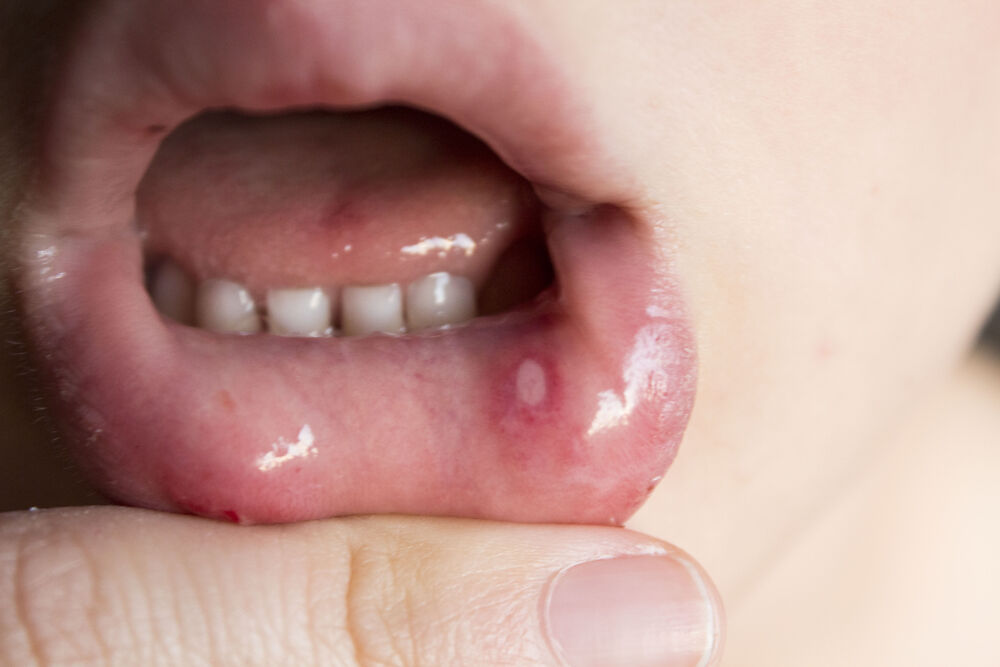 Trẻ bị nổi mụn nước trong miệng là bệnh gì? Cách khắc phục ra sao?