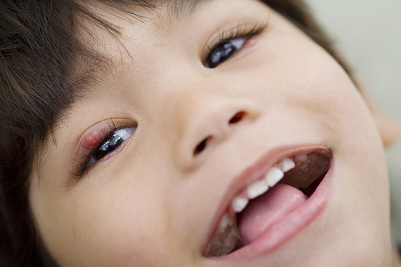 Trẻ bị sưng mí mắt trên: Nguyên nhân và cách phòng ngừa
