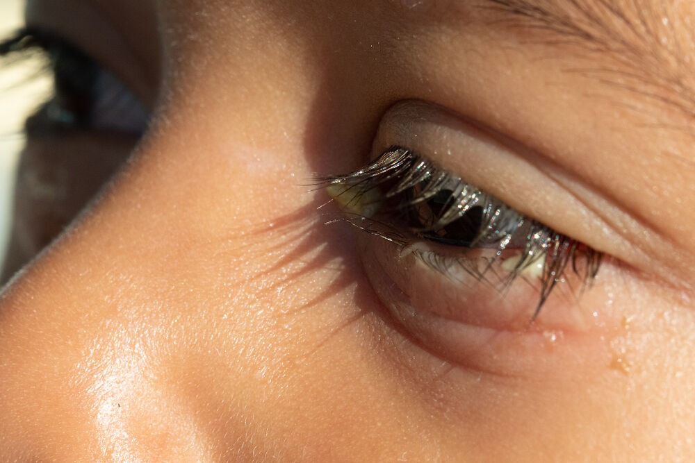 bé 2-3 tuổi mắt bị đổ ghèn
