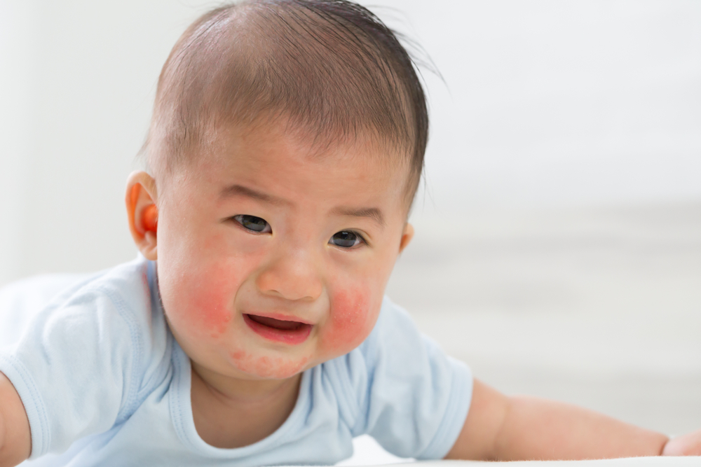 Trẻ sơ sinh bị nổi mẩn đỏ ở mặt là bệnh gì? Nguyên nhân và cách chữa trị