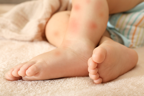Trẻ sơ sinh bị mẩn đỏ ở mặt do dị ứng