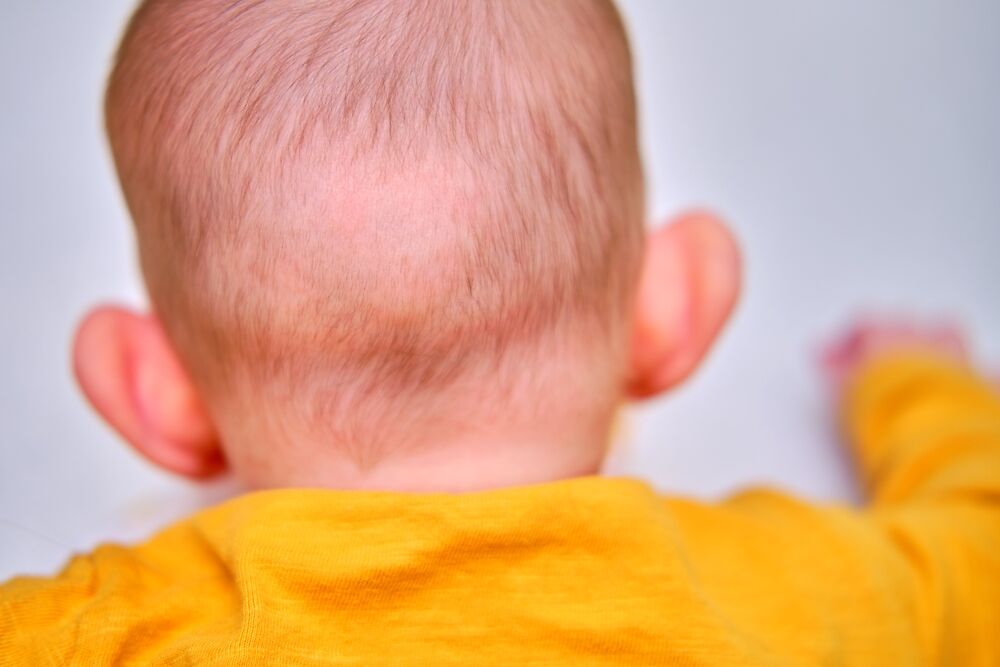 rụng tóc vành khăn ở trẻ sơ sinh là gì?