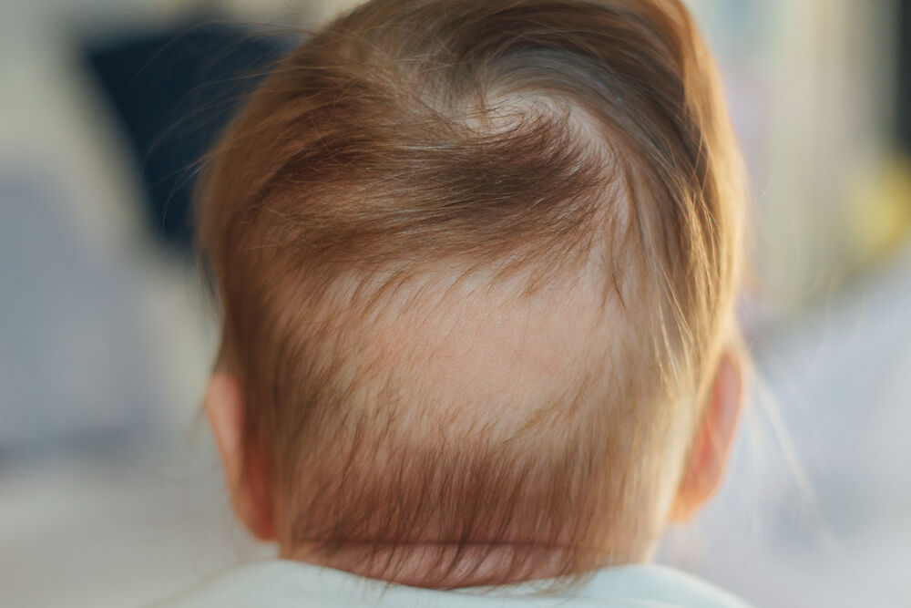 Trẻ sơ sinh bị rụng tóc vành khăn có đáng lo?