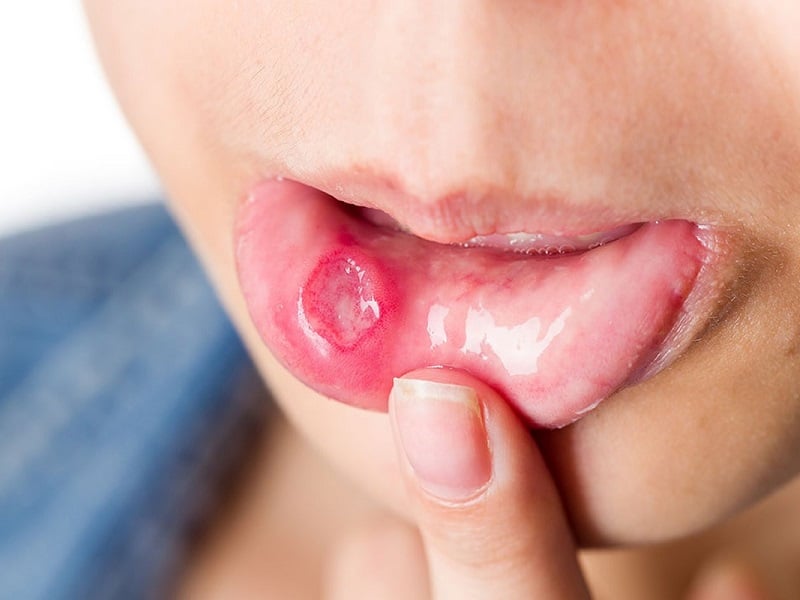 Trẻ bị nhiệt miệng: Nguyên nhân, cách chữa trị và phòng ngừa