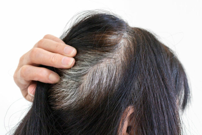 7 cách trị tóc bạc sớm để lấy lại tuổi xuân • Hello Bacsi