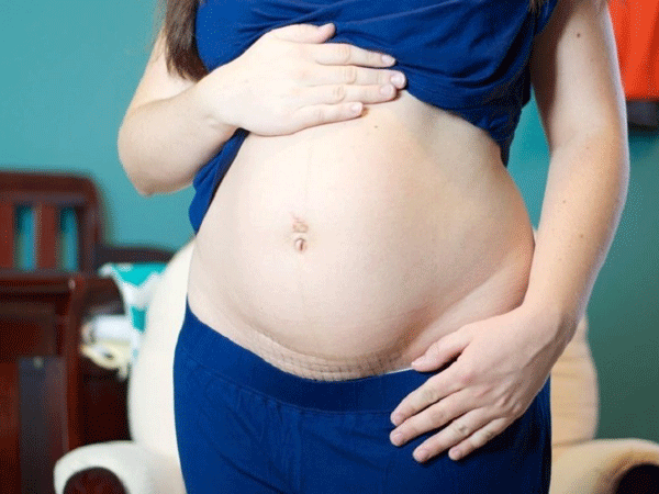 10 điều nhất định phải biết về vết mổ sau sinh