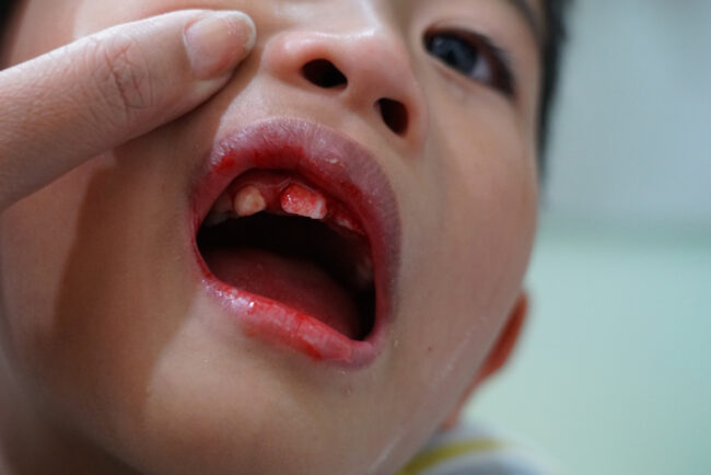 Cách chữa chảy máu chân răng ở trẻ em đơn giản, hiệu quả mẹ cần biết