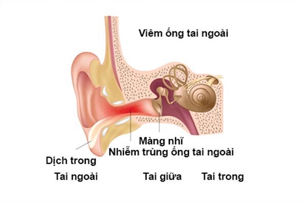 Hình ảnh viêm tai ngoài ở trẻ sơ sinh