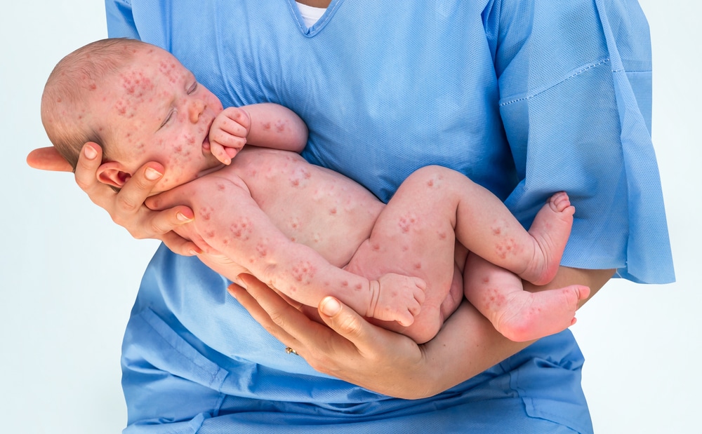 Dấu hiệu và triệu chứng thủy đậu ở trẻ sơ sinh