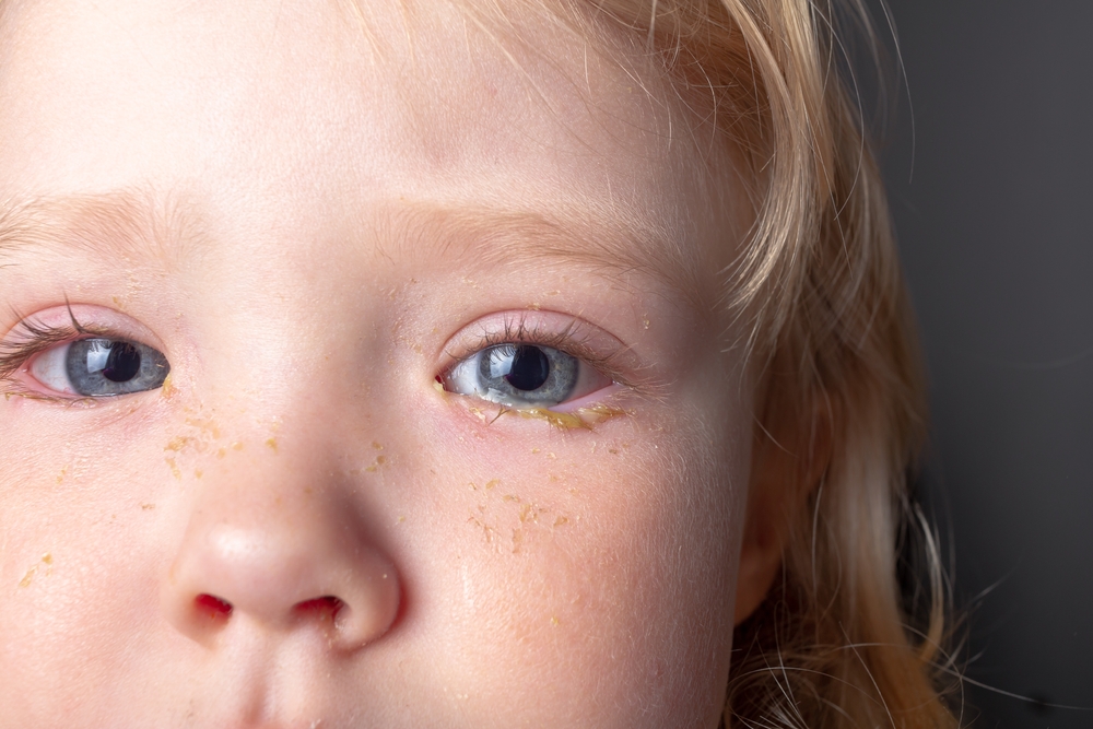 Mắt trẻ sơ sinh bị ghèn phải làm sao để khắc phục?