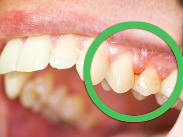 Làm gì để ngưng chảy máu chân răng?