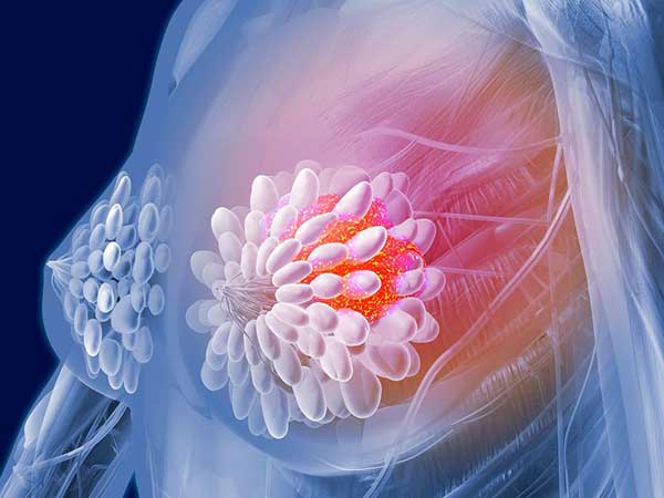 4 dấu hiệu ung thư vú khác ngoài biểu hiện khối u bạn nên biết