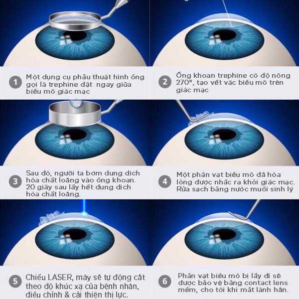 Phẫu thuật mắt cận Lasek