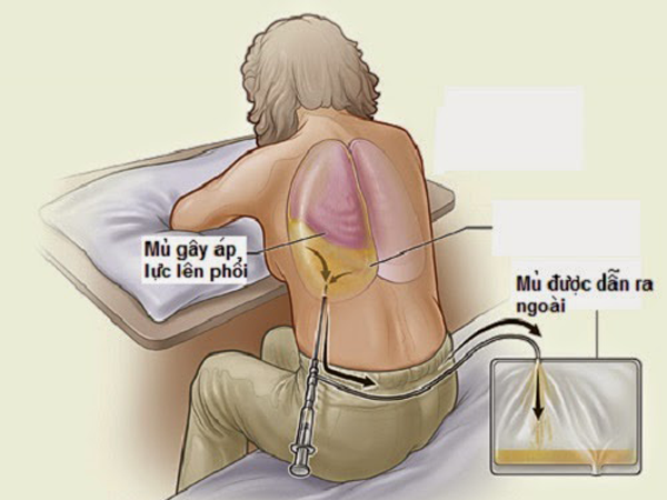 tràn dịch màng phổi 2