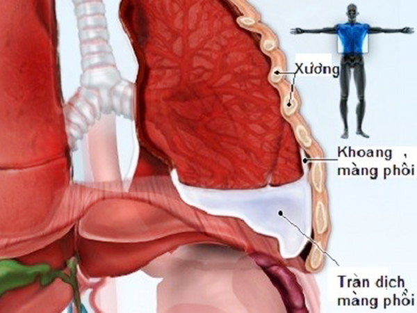 Tràn dịch màng phổi và những dấu hiệu cảnh báo nguy hiểm cho sức khỏe