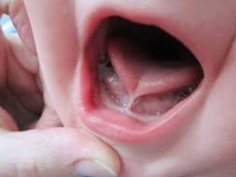 Cách nhận biết bé bị dính thắng lưỡi và hướng điều trị