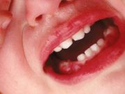 Trẻ bị viêm nướu cần được chăm sóc như thế nào?
