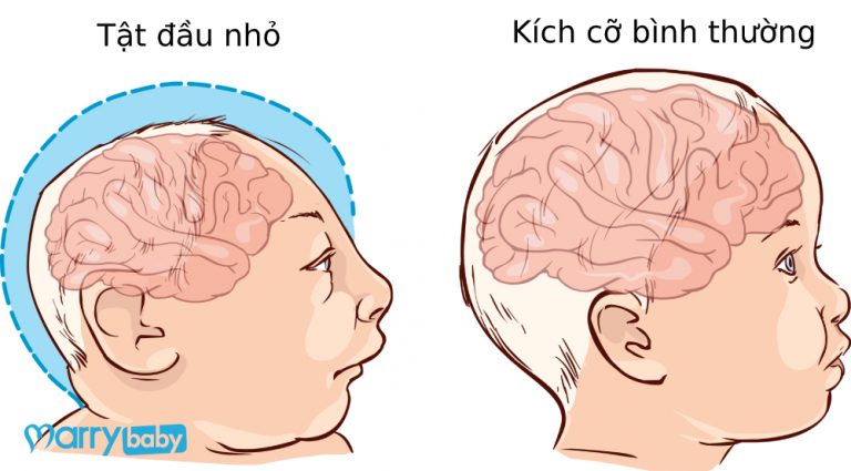 Bệnh teo não ở trẻ em, làm sao để tránh?