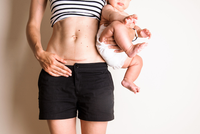 Sinh mổ có để lại sẹo không