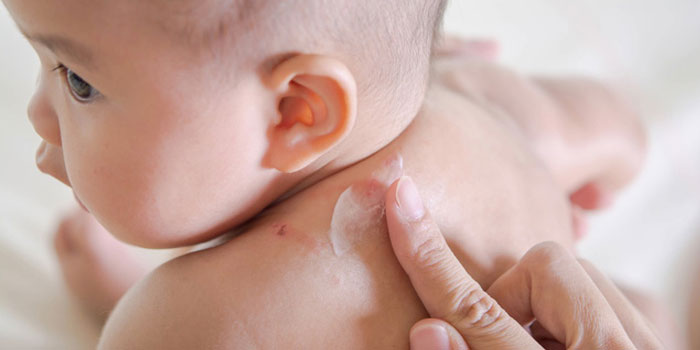 Top 6 kem trị rôm sảy cho trẻ sơ sinh an toàn và hiệu quả nhất