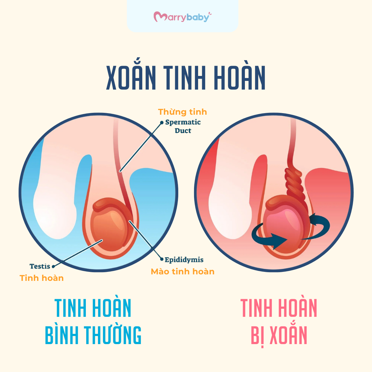 Xoắn ruột thừa tinh hoàn sẽ khiến bé trai bị đau