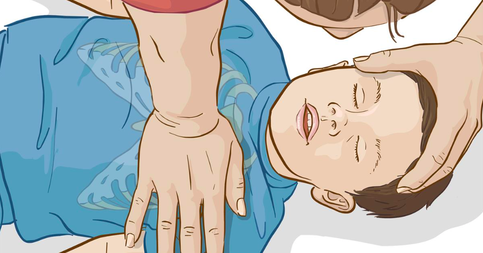 Sơ cứu gãy xương: Dùng 1 gan bàn tay ép ngực 30 lần