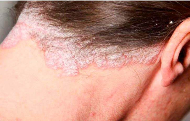 dấu hiệu bệnh vảy nến da đầu 