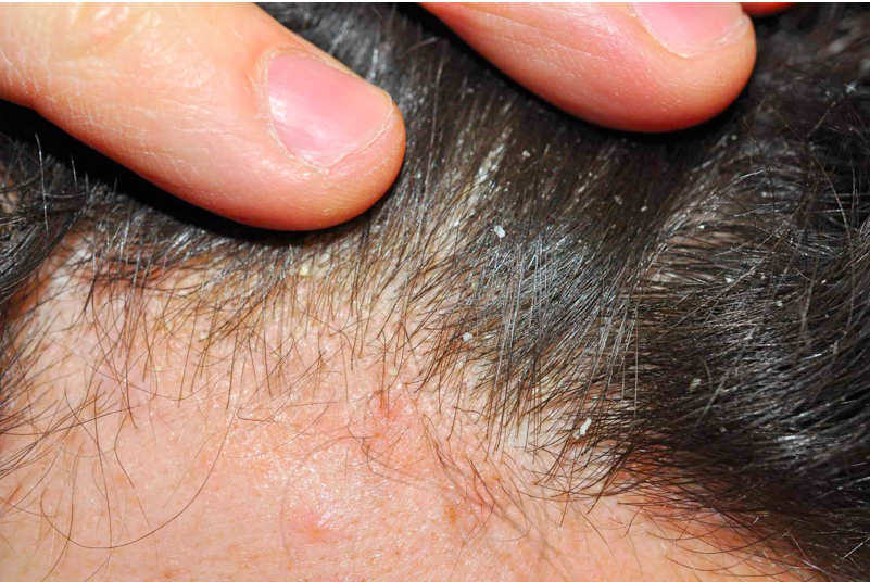 bệnh vẩy nến da đầu giống với tình trạng gàu