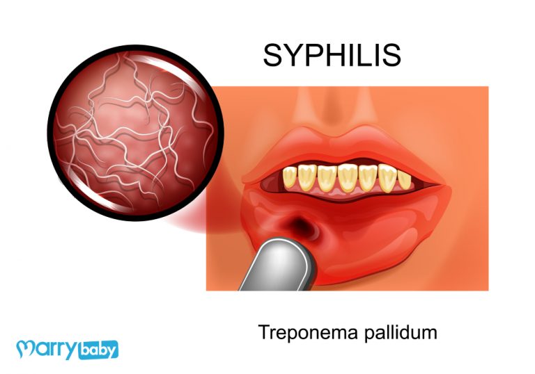 Đặc điểm của bệnh giang mai ở miệng mẹ nên phát hiện sớm