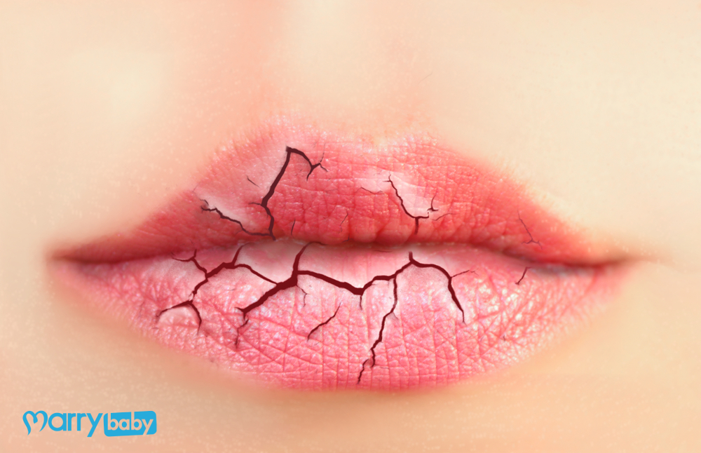 9 mẹo trị môi khô nứt nẻ quanh năm giúp môi luôn căng bóng