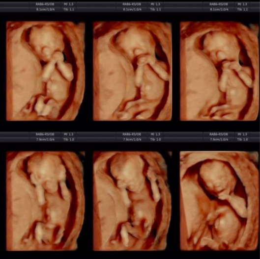 Hình ảnh siêu âm thai nhi 15 tuần tuổi