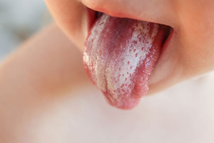 các bệnh về lưỡi ở trẻ em: Lưỡi trắng