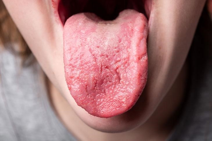 các bệnh về lưỡi ở trẻ em: Viêm lưỡi bệnh lý