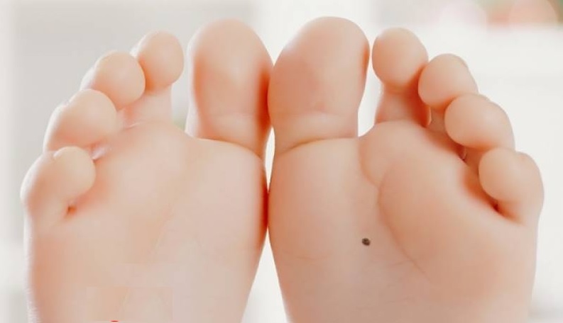 Nốt ruồi ở dưới lòng bàn chân