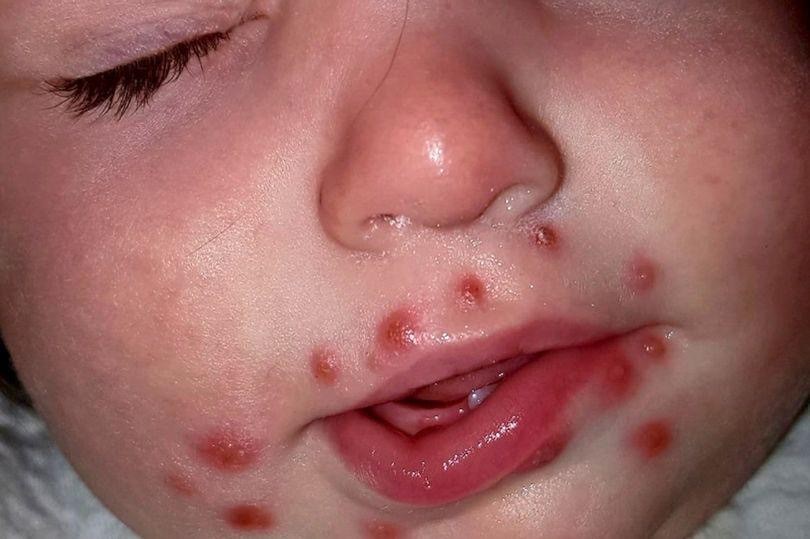 bệnh herpes khiến trẻ nổi bóng nước trên da