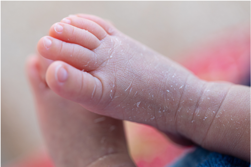 khô da gây ngứa lòng bàn chân ở trẻ em