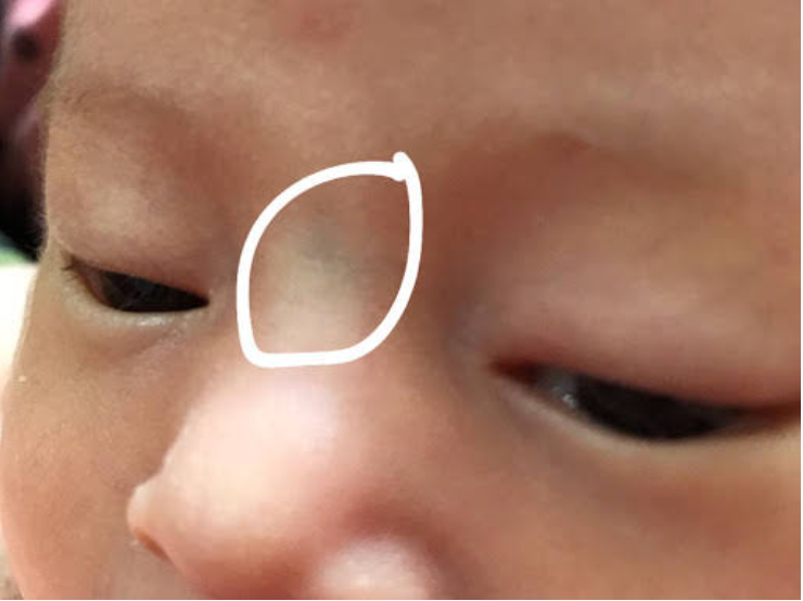 nguyên nhân trẻ có gân xanh ở sống mũi