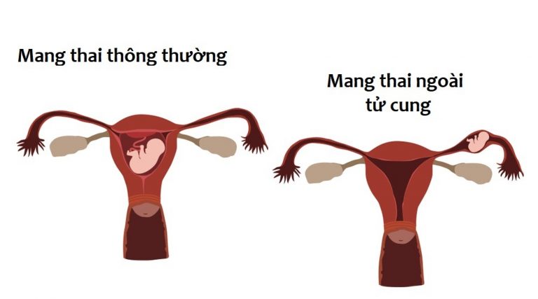 Thai ngoài tử cung thử que có biết không? Vấn đề không của riêng ai