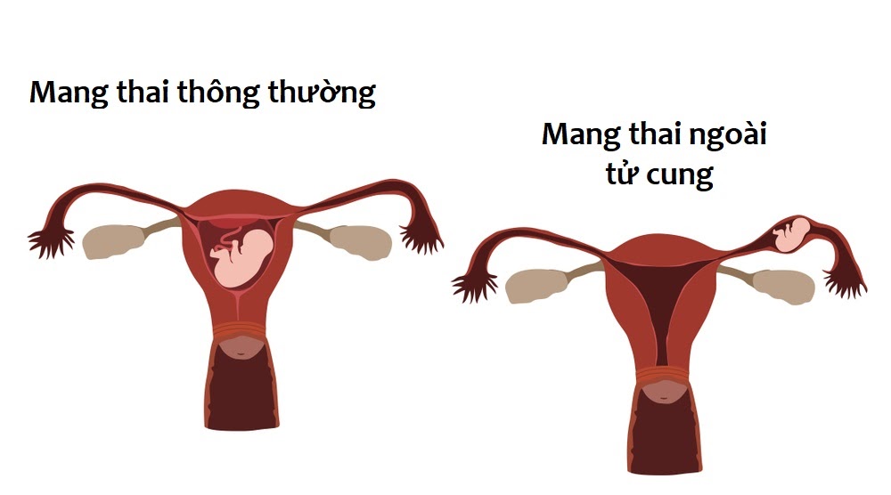 Thai ngoài tử cung thử que có biết không